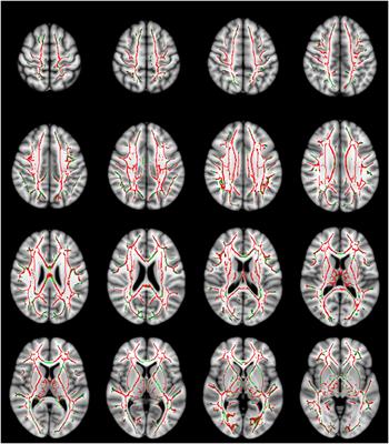 Investigating Microstructural Abnormalities and Neurocognition in Sub-Acute and Chronic Traumatic Brain Injury Patients with Normal-Appearing White Matter: A Preliminary Diffusion Tensor Imaging Study